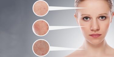 acne behandeling puistjes
