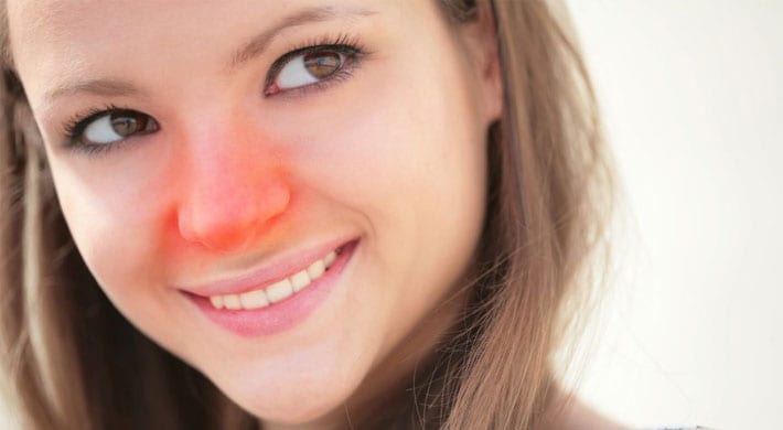 Fabel veelbelovend Draak Rode neus – 8 oorzaken van een rode neus + oplossing - Gezondr.nl