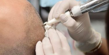 Tricopigmentatie tegen haarverlies & kaalheid bij mannen