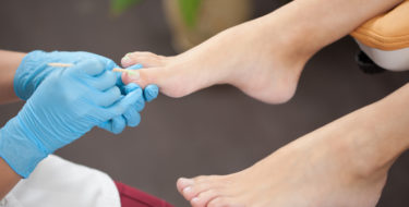 schimmelnagelbehandeling schimmelnagels behandelen