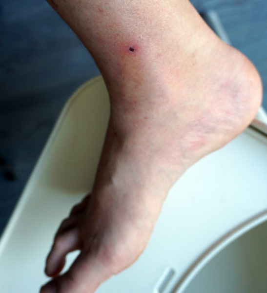 Stekende vliegjes!? Gestoken door klein steekvliegje Blandford Fly